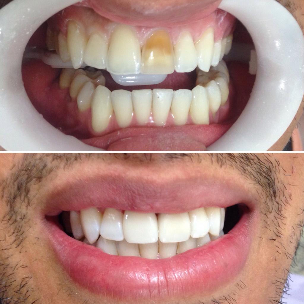 Antes e depois - resultado
